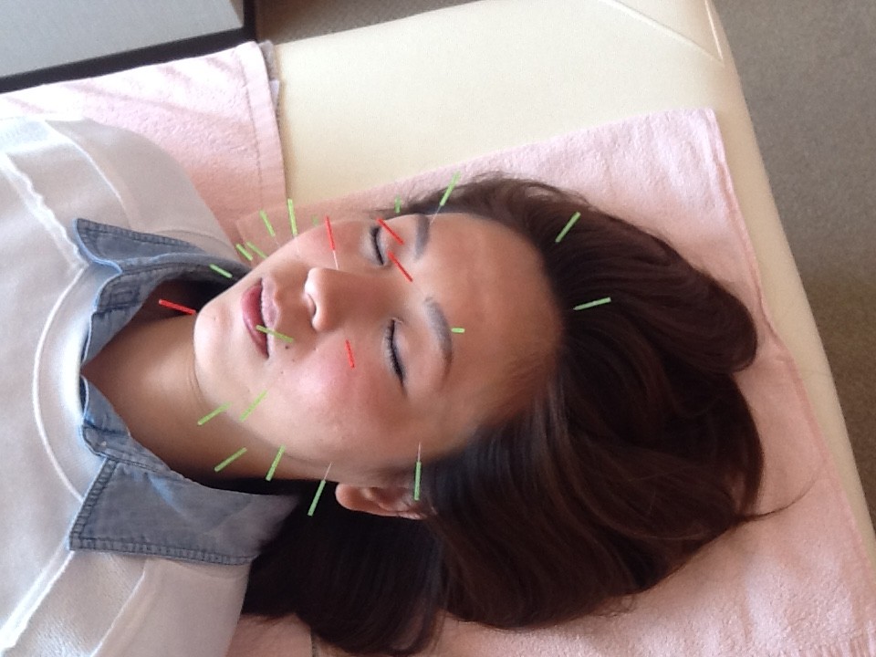 美容鍼灸