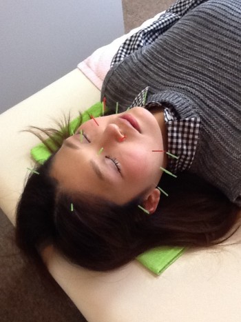美容鍼灸