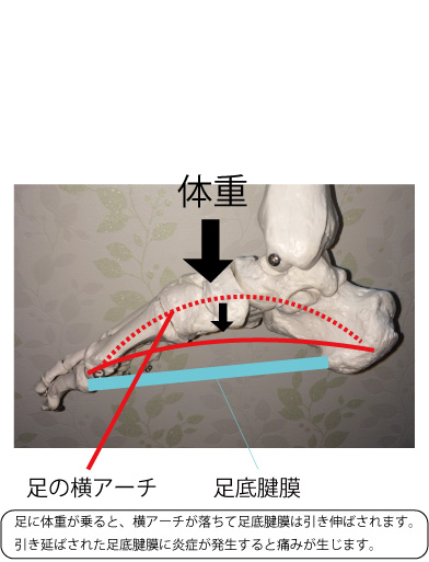 足底筋膜炎