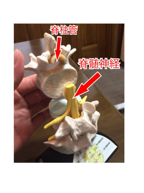 坐骨神経痛 脊柱管狭窄症