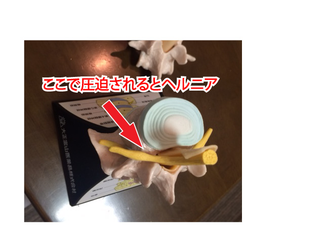 腰椎椎間板ヘルニア 模型