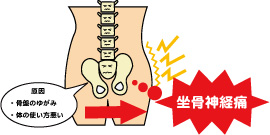 坐骨神経痛 施術